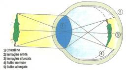 Un occhio miope è così