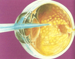 La retina malata provoca la visione di lampi di luce. Non bisogna mai sottovalutare tali sensazioni visive.